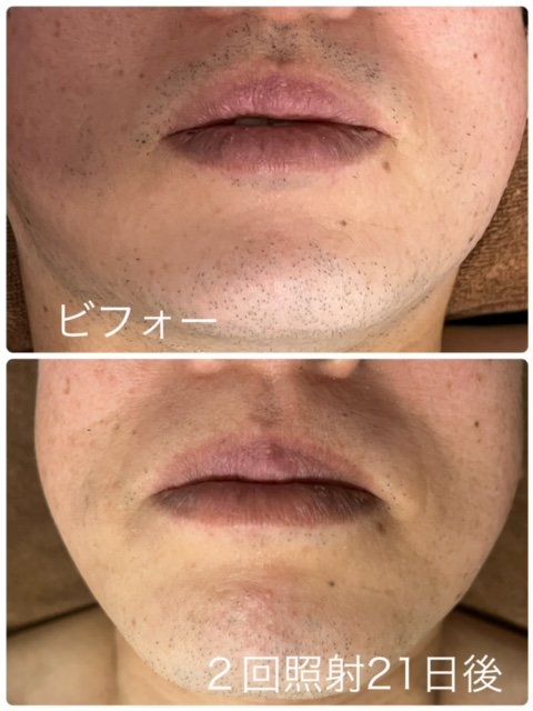 ヒゲ脱毛モニター様経過